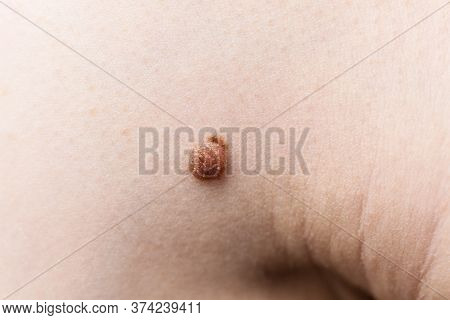 Unrecognizable Person Having Dark Fibroma, Dermatology Problem On Skin. Close Up Of Papilloma Dermat