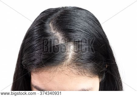 Women Head With Dandruff Caused By The Problem Of Dirty. Or Caused By Skin Disease Or Seborrheic Der