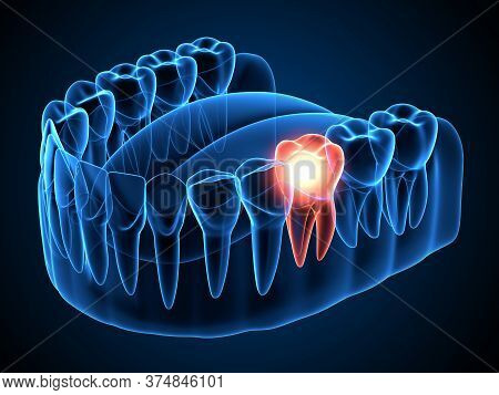 3d Render Of  Jaw X-ray With Aching Molar Tooth. Toothache Concept.