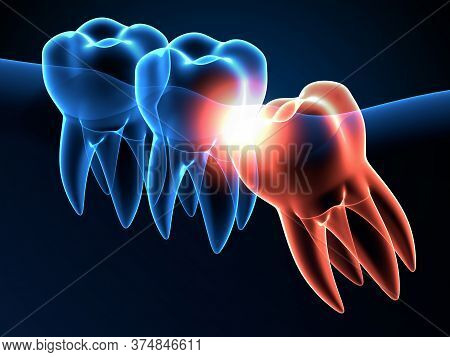3d Render Of Jaw X-ray With Wisdom Mesial Impaction . Concept Of Different Types Of Wisdom Teeth Pro