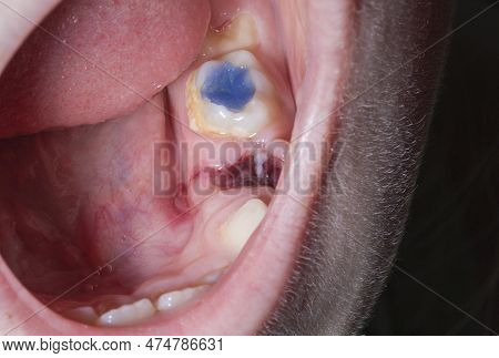 An Open Child's Mouth With A Pulled Out Tooth And Blood In The Gum. Extraction Of Milk Teeth In Chil