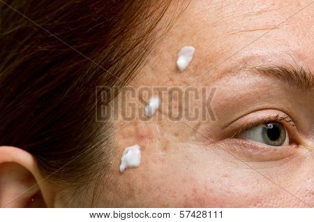 Acne Treatment