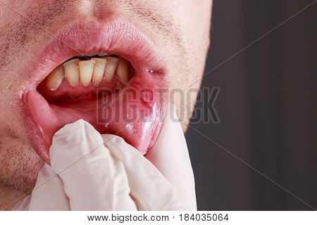 Stomatitis on the lips of a man