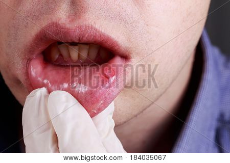Stomatitis on the lips of a man