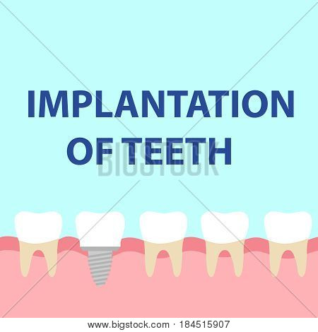 Dental implant model. Flat design vector illustration vector.