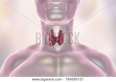 Thyroid cancer. 3D illustration showing thyroid gland with tumor inside human body