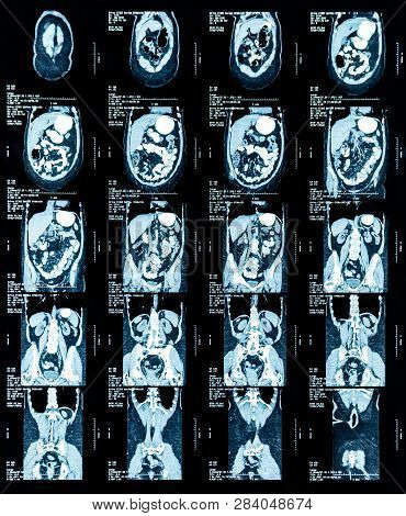 Mri Scan Image Of Chest And Abdomen. Medical Diagnostic