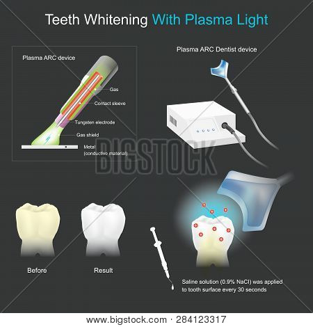 Causes The Stains Colour On The Tooth Surface To Disappear By Using Chemical And Electrical Methods