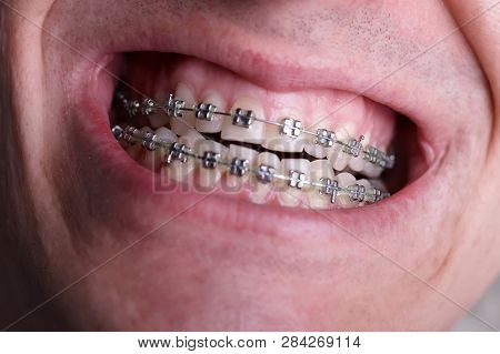 Metal Orthodontic Braces On Crooked Ugly Teeth Close-up. Ugly Smile. Dental Concept, Medicinal Align