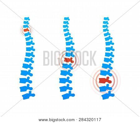 Vector Human Spine With Pain Isolated Silhouette Illustration. Spine Pain Medical Center, Clinic, Re
