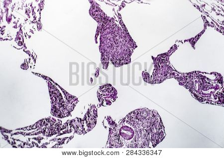 Histopathology Of Lung Emphysema, Light Micrograph, Photo Under Microscope Showing Enlargement Of Ai