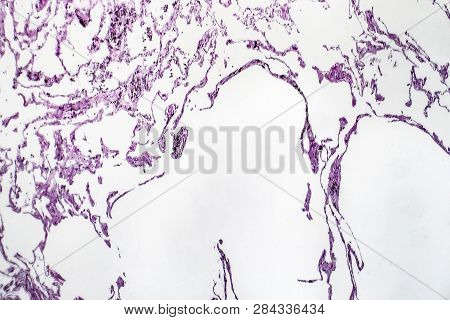 Histopathology Of Lung Emphysema, Light Micrograph, Photo Under Microscope Showing Enlargement Of Ai