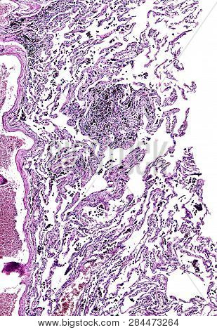 Histology Of Human Tissue, Show Lung Of Smoking As Seen Under The Microscope, 10x Zoom