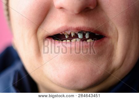 Close-up Of A Womans Face With Rotten And Dying Teeth