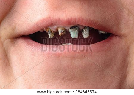 Close-up Of A Womans Face With Rotten And Dying Teeth