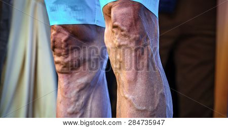 Cyclist Legs With Varicose And Protruded Veins, Front View