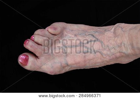 Reumatica Arthritis. Foot From Women 85 Years Old. Reumatica Since 45 Years.
