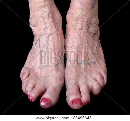 Feets With Reumatica Arthritis. Women 85 Years Old And Have Had Arthrits Since 45 Years.