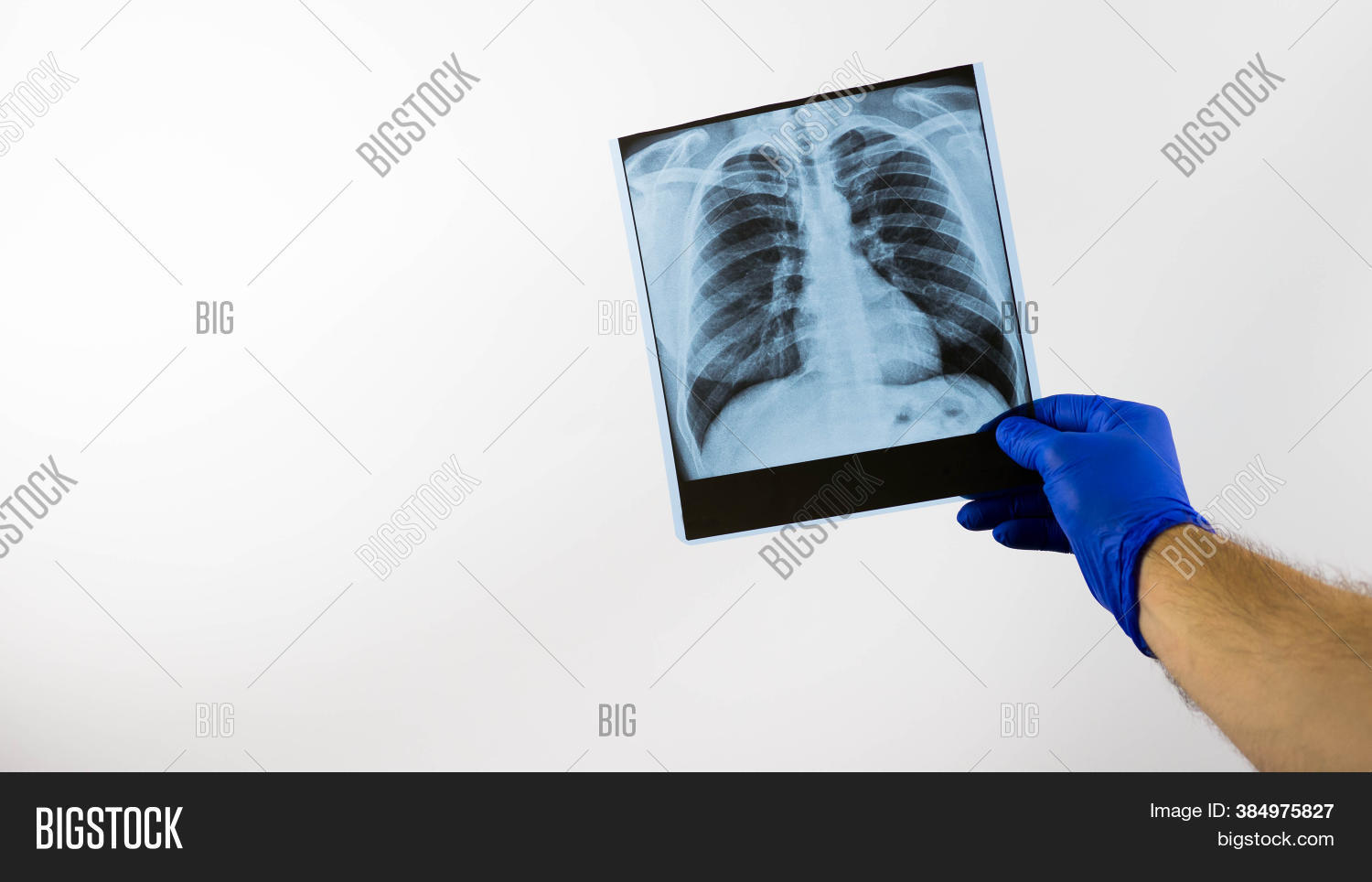 X-ray Person's Lungs Image & Photo (Free Trial) | Bigstock