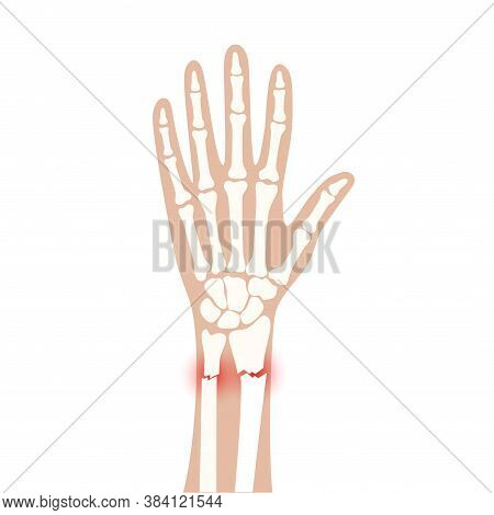 X Ray Of Arm Fracture With Red Pain Or Inflammation Points. Broken Hand With Inner Closed Radius Typ