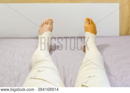 Human Legs Completely Tight Wrapped With Woven Elastic Medical Bandages And Fixed With Clips After S