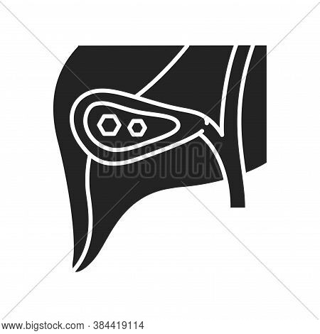 Pancreatic Stones Black Glyph Icon. Acute Pancreatitis. Human Organ Concept. Sign For Web Page, Mobi