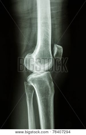 Normal Human's Knee Joint
