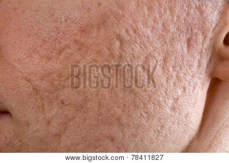 Acne Scars On Cheek