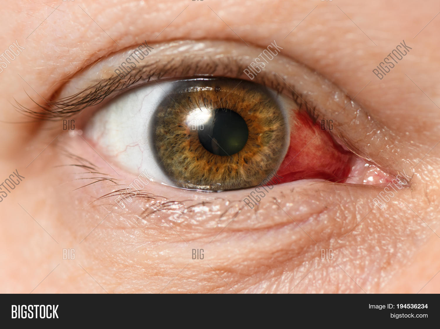 Subconjunctival Image & Photo (Free Trial) Bigstock