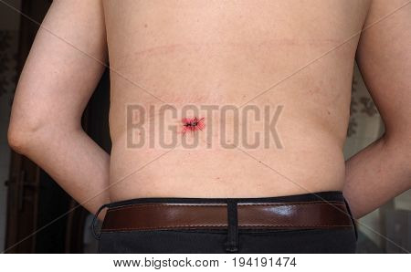 Surgical Wound With Stitches And Iodine Tincture