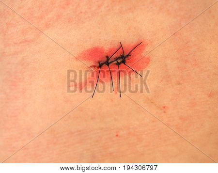 Surgical Wound With Stitches And Iodine Tincture