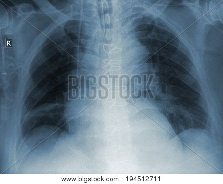 Patient radiogram with health pathology. Medical examination