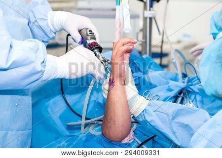 Group Of Orthopedic Surgeons Performing A Wrist Arthroscopy On A Male Patient