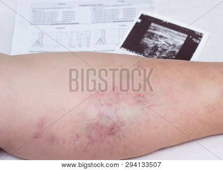 Leg Of An Elderly Woman With Varicose Veins, Close-up, Ultrasound Examination Documents, Phlebeurysm