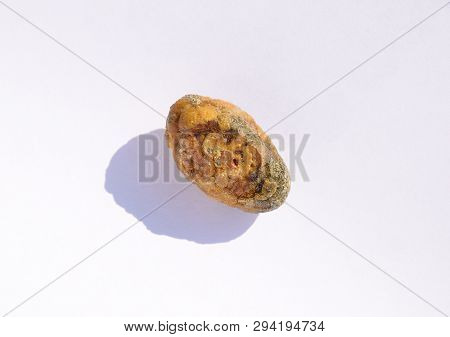 Stone Of The Gallbladder. The Result Of Gallstones. A Calculus Of Heterogeneous Composition.