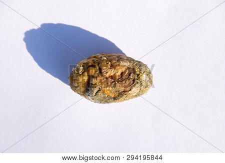 Stone Of The Gallbladder. The Result Of Gallstones. A Calculus Of Heterogeneous Composition.