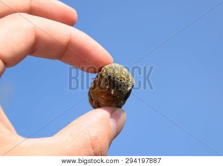 Stone Of The Gallbladder. The Result Of Gallstones. A Calculus Of Heterogeneous Composition Against 