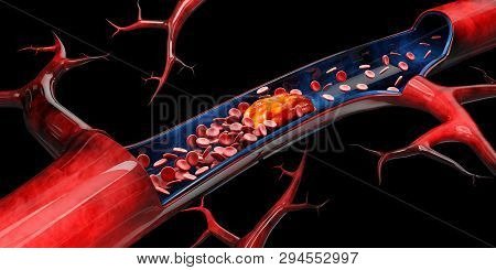 3dillustration Of Cerebral Sclerosis Isolated Black Background