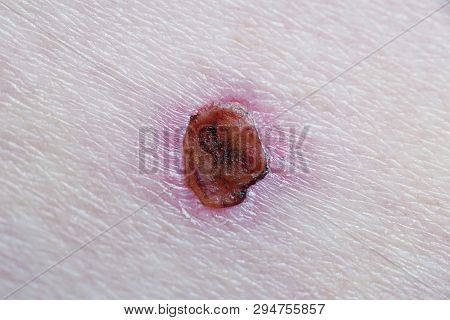 Healing Wound With Scab After Basal Cell Skin Cancer Laser Treatment