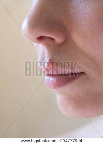 Cold Sores. Close-up Of The Female Face, Selective Focus.