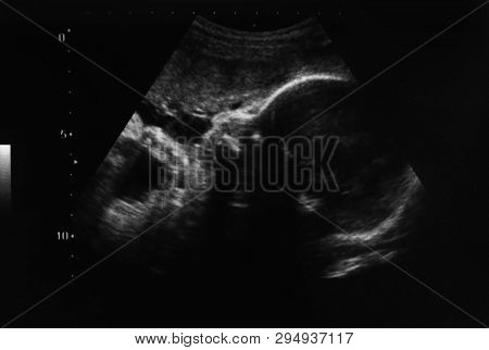 Ultrasound Photo Of Unborn Baby In Mother's Womb, Closeup View