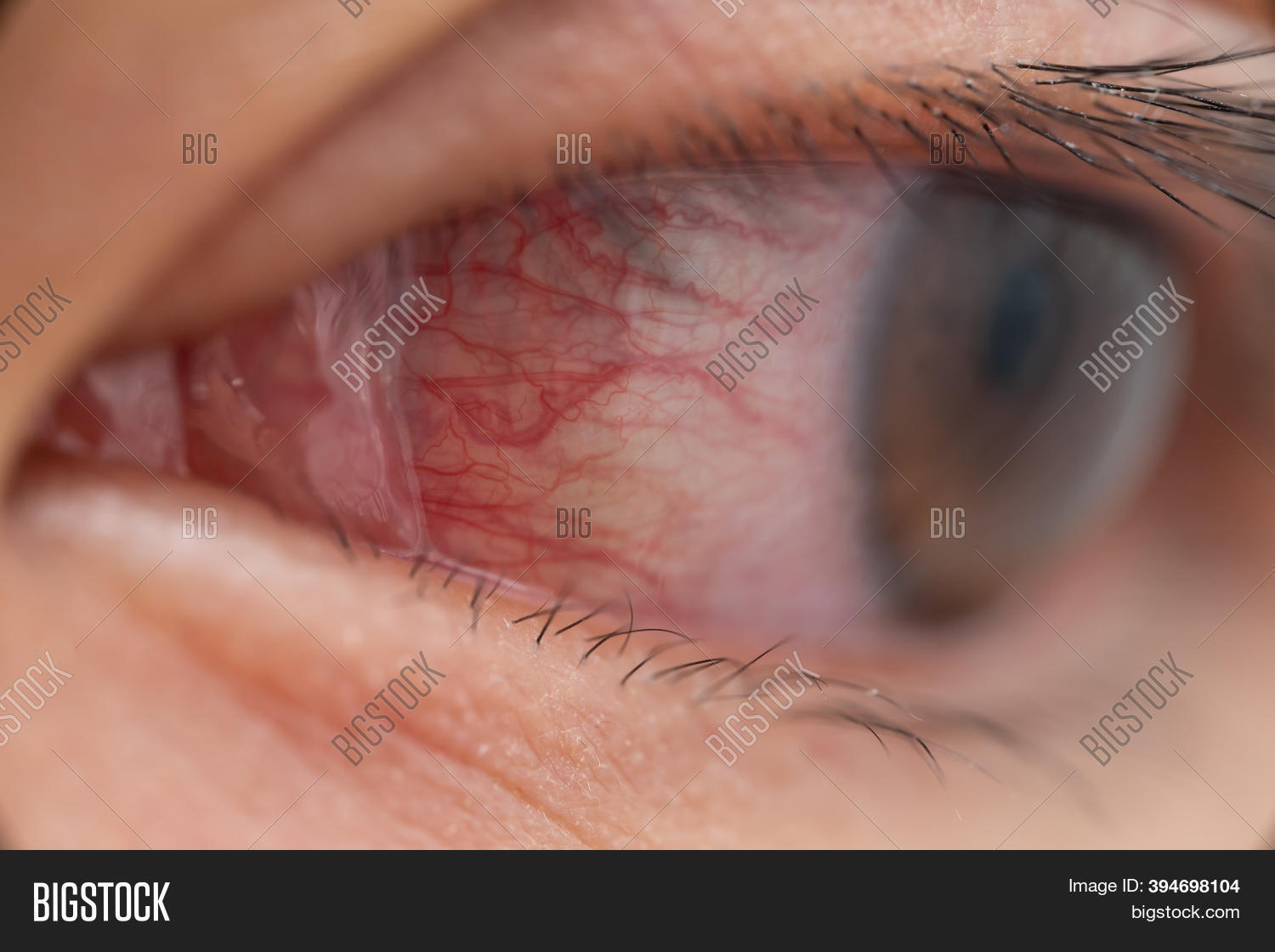 Closeup Irritated Image & Photo (Free Trial) Bigstock