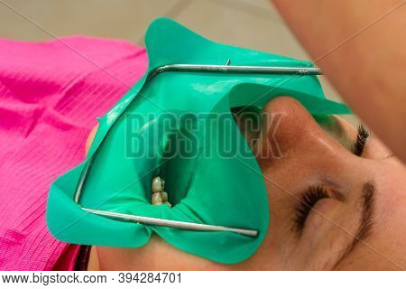 Installation Of A Cofferdam To The Patient, Modern Dental Equipment, Treatment In Sterile Conditions
