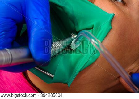 Dentist Treats The Tooth With Modern Methods, Uses A Rubber Dam, Sterile Tooth Treatment.