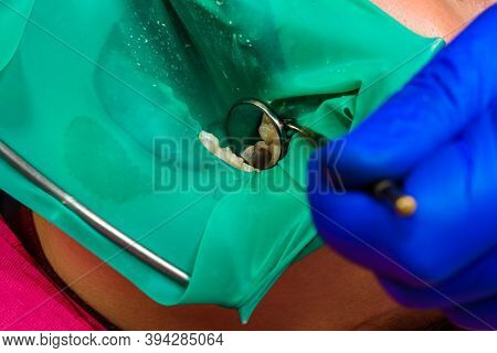 Treatment Of Posterior Tooth, Mouth Covered With Rubber Dam, Sterile Treatment With Modern Technolog