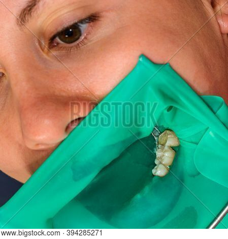 Treatment Of A Chewing Tooth, The Dentist Put A Rubber Dam, Uses Sterile Tools, Uses Modern Technolo