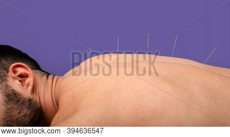 Man Getting Acupuncture Treatment. Acupuncture Needles Close Up On Violet Background
