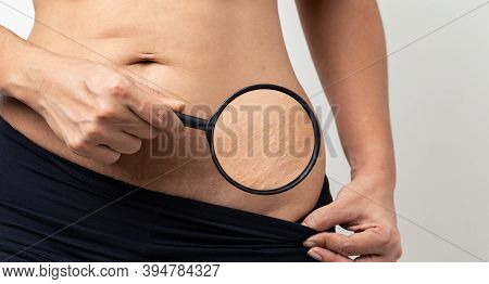 Stretch Marks, Women Show Off The Belly After Birth On White Background