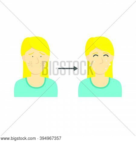 Blonde Woman Or Girl From Acne Face To Clean Face Diagram Infographic Illustration