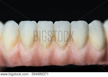 Dental Health Care. Close Up Ceramic Zirconium. Dental Prosthesis On Zirconium Oxide Implants